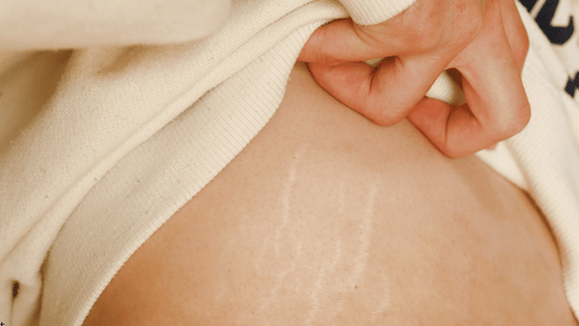 Microneedling används ibland för att förbättra utseendet på bristningar genom att stimulera hudens kollagenproduktion.