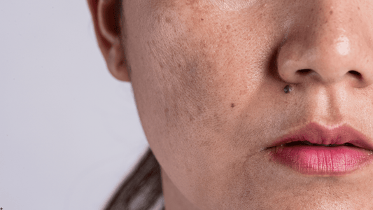 Hud med pigmentförändringar som kan behandlas med microneedling