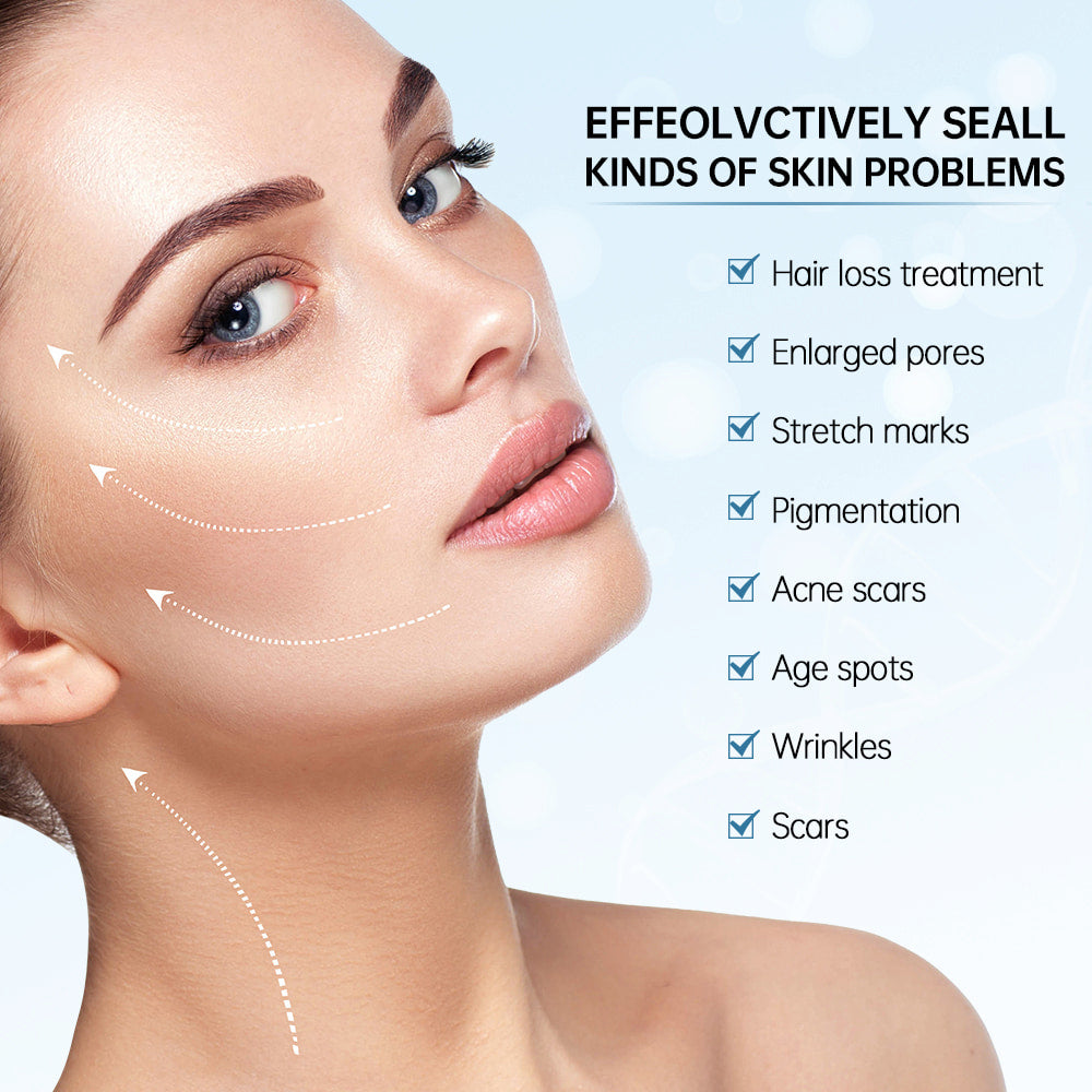 Kvinna som visar resultat av microneedling för behandling av hudproblem såsom stora porer, ärr, acneärr, pigmentfläckar, rynkor och fina linjer.